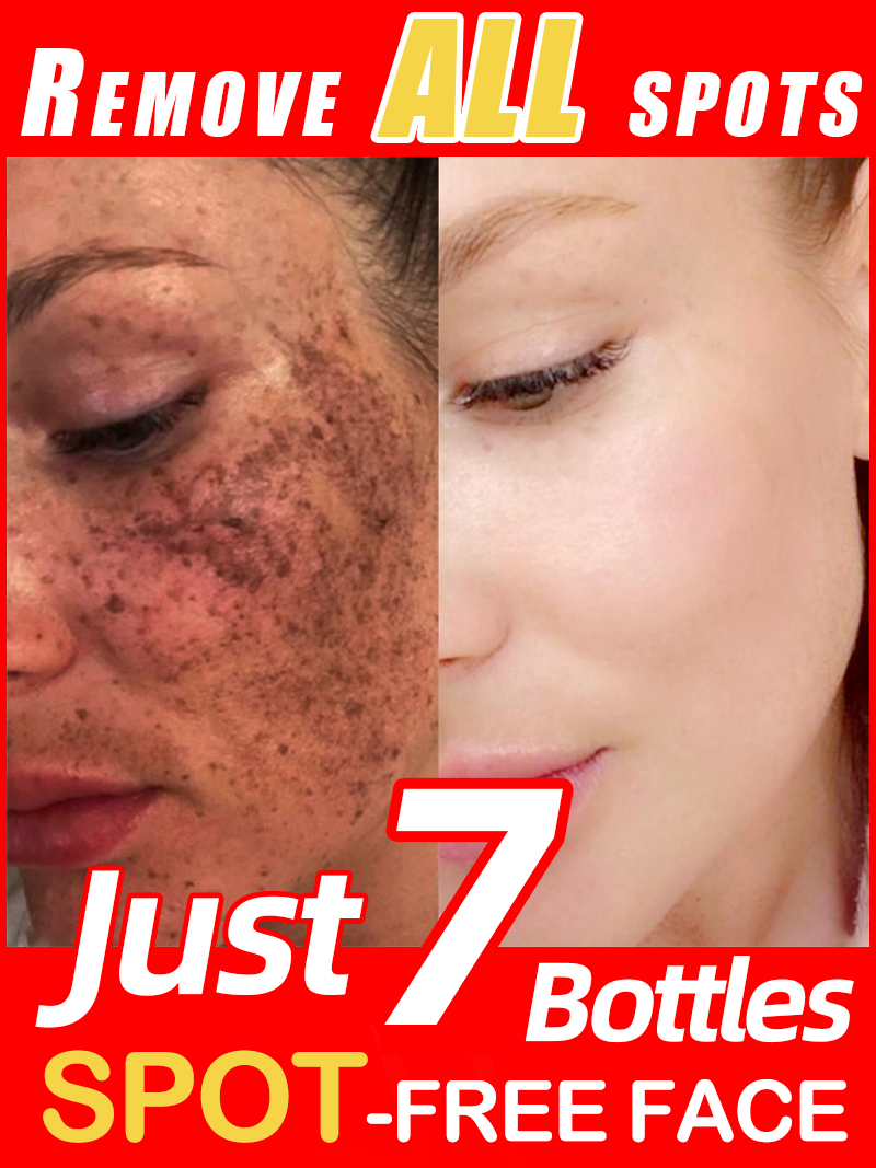 Ilumina las pecas Melasma, las - Luxury Natural Skincare reseña y precio